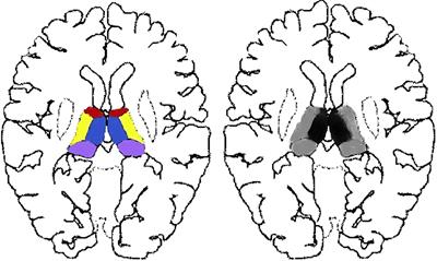 Volume mismatch indicates tumors in paramedial bithalamic diseases: a retrospective study